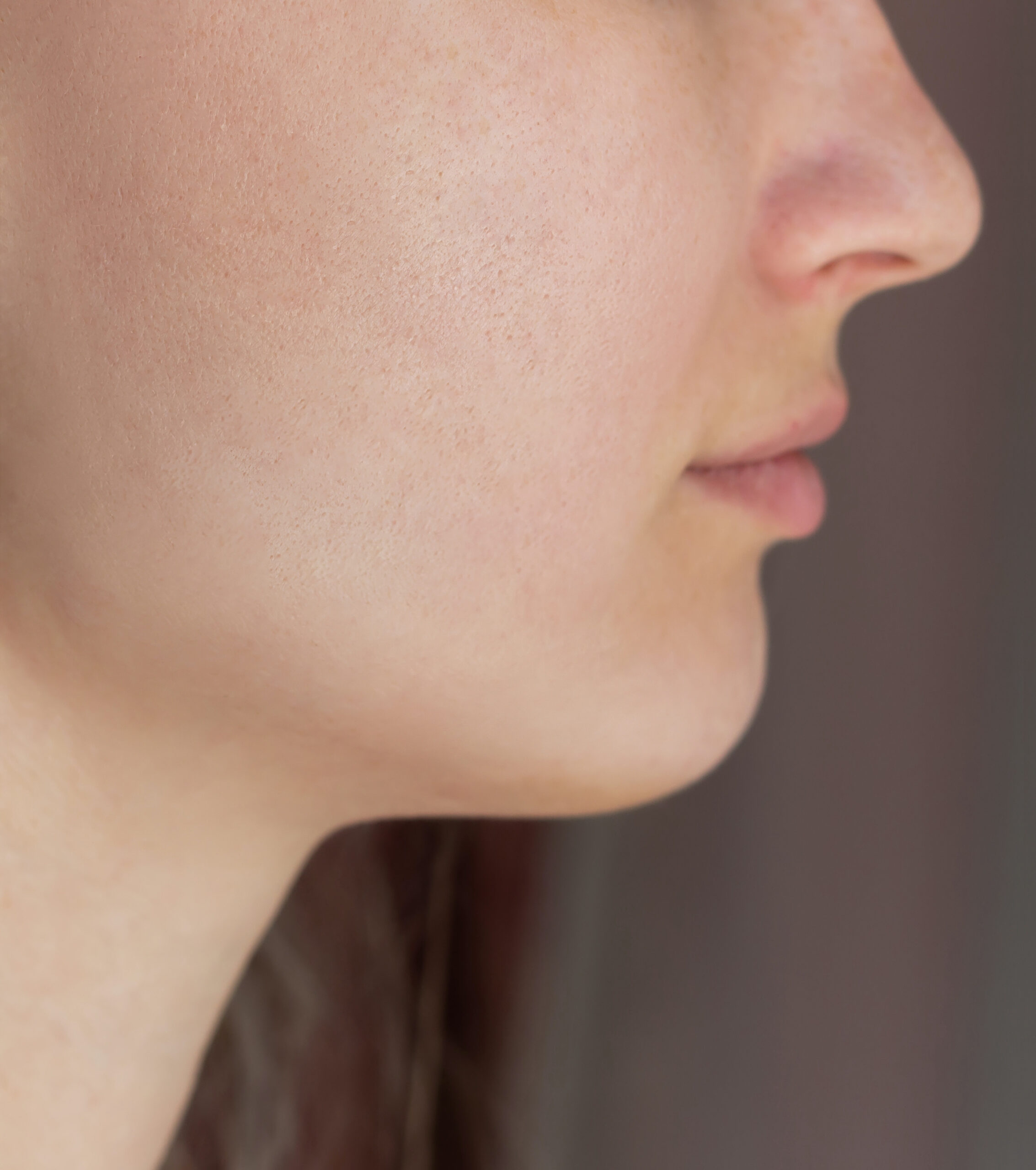 cropped shot young womans face before after acne treatment face pimples rash cheeks copy scaled