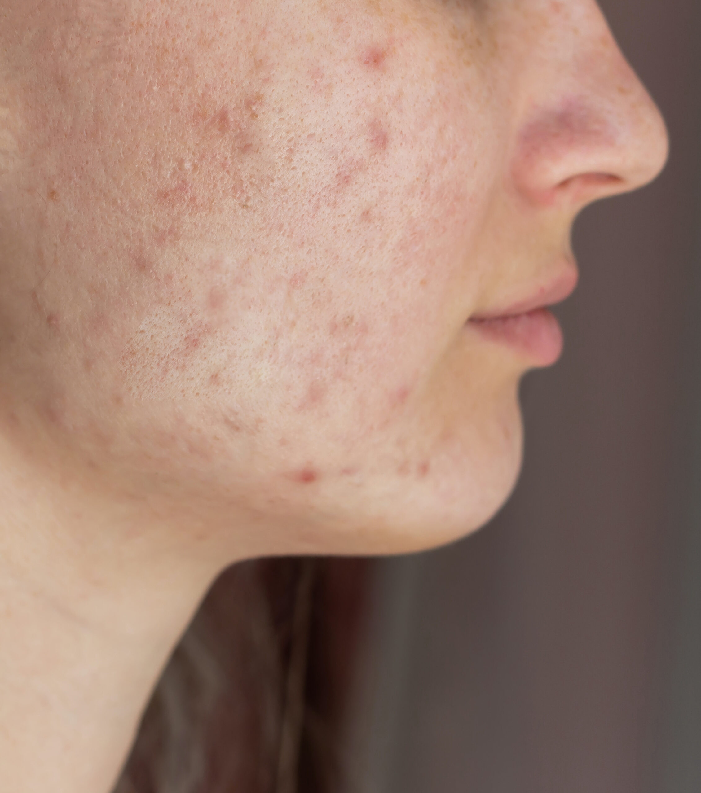 cropped shot young womans face before after acne treatment face pimples rash cheeks scaled