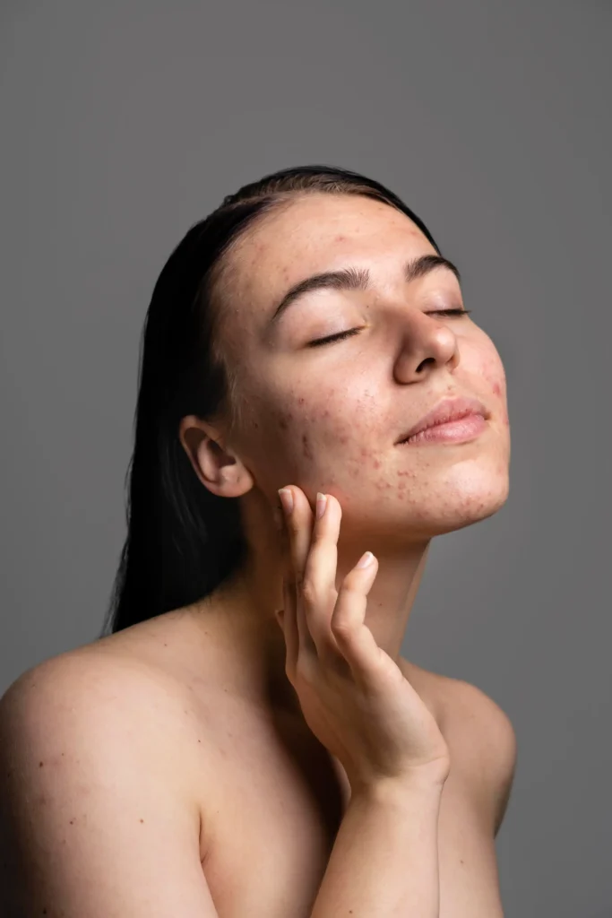 acne treatment facials