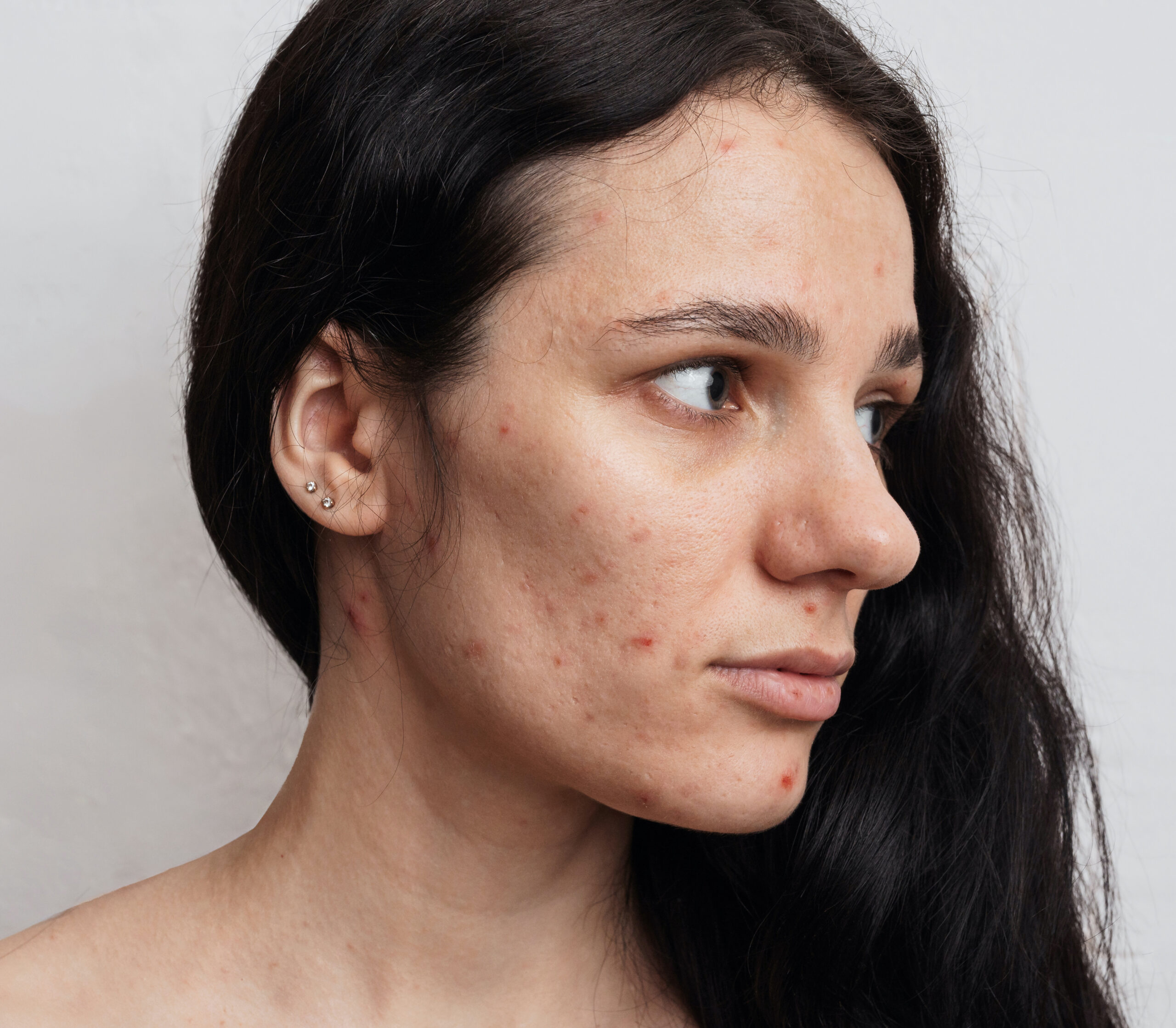 young woman before after acne treatment beige background copy scaled