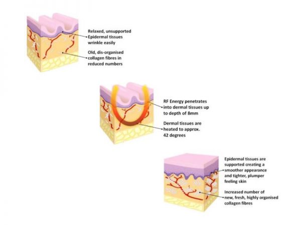 An artistic illustration showing radiofrequency energy waves penetrating skin layers, causing collagen fibers to contract and tighten, explaining the RF facelift mechanism.