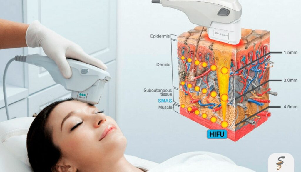 ultrasound facelift hifu cfu dubai the non surgical lift explained featured