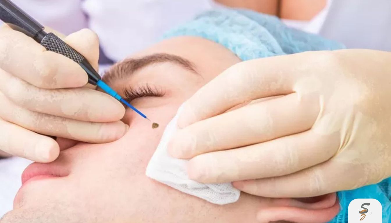 Dermatologist performing a quick, precise in-clinic skin tag removal procedure in a clean treatment room.