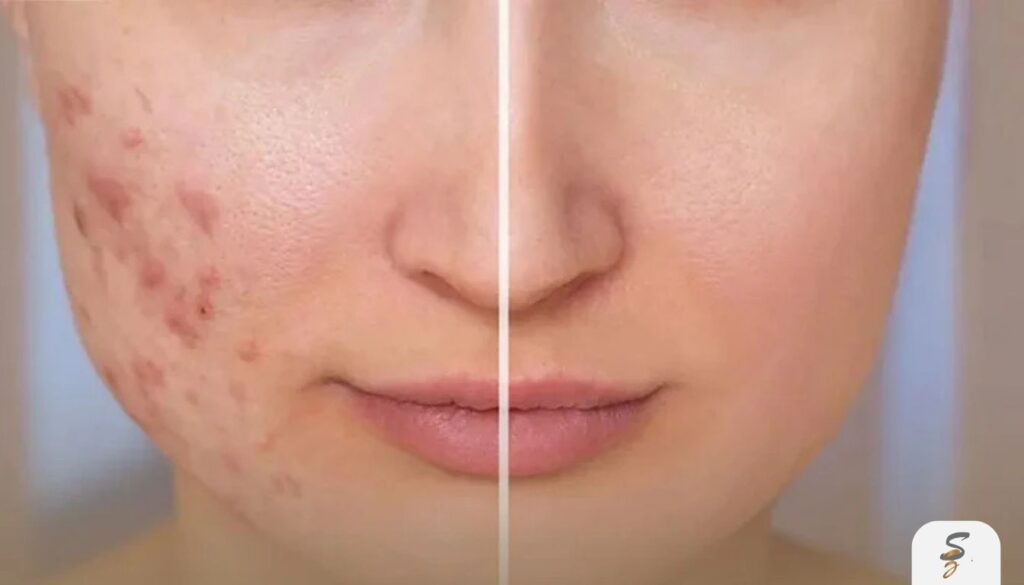 advanced scar treatment in dubai from acne to c sections featured