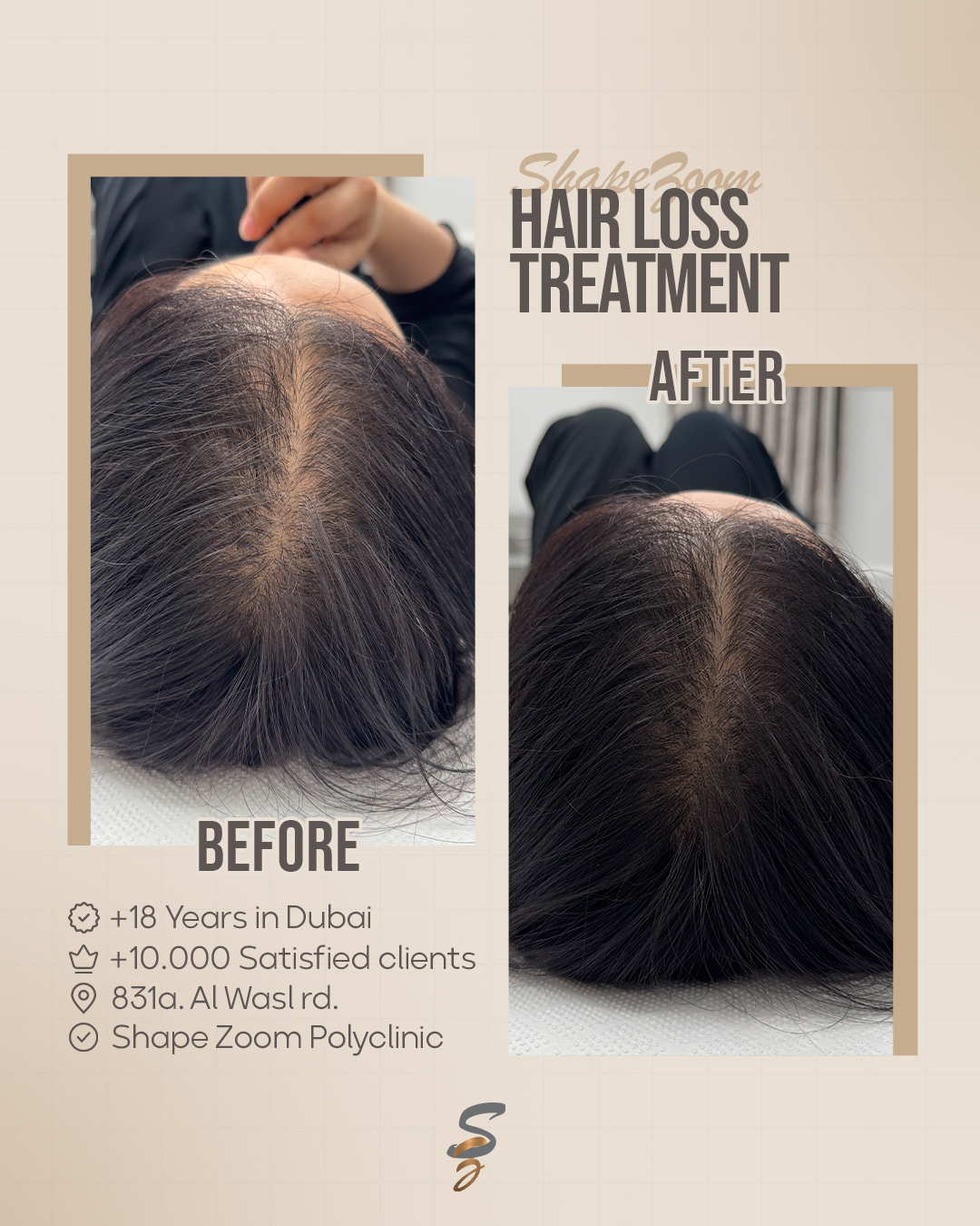 Hair Loss Treatment Result